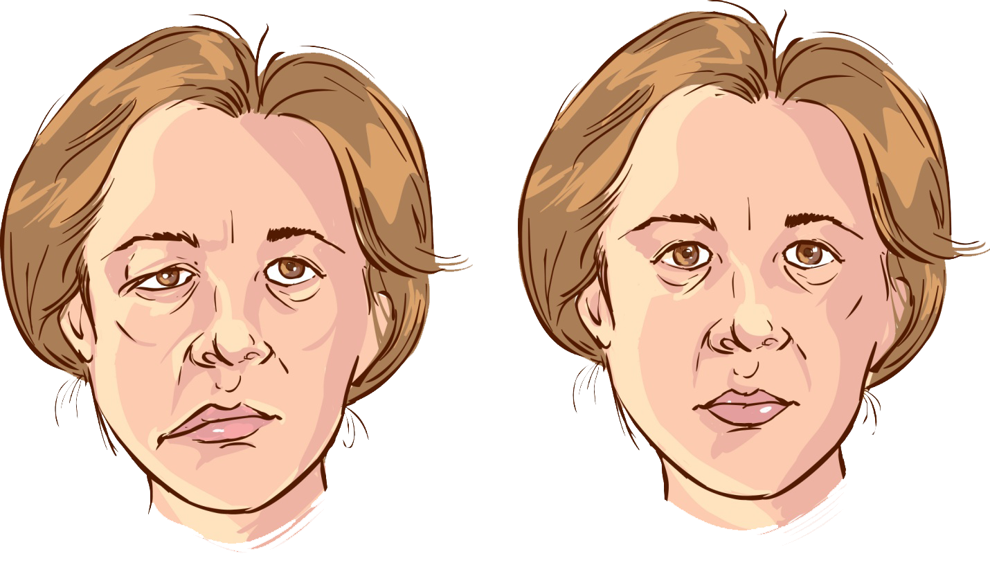 What is Facial Palsy?